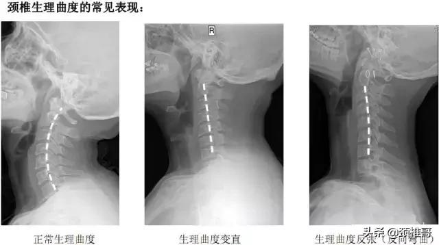 颈椎生理曲度反弓可以去健身房吗,颈椎病反弓原理