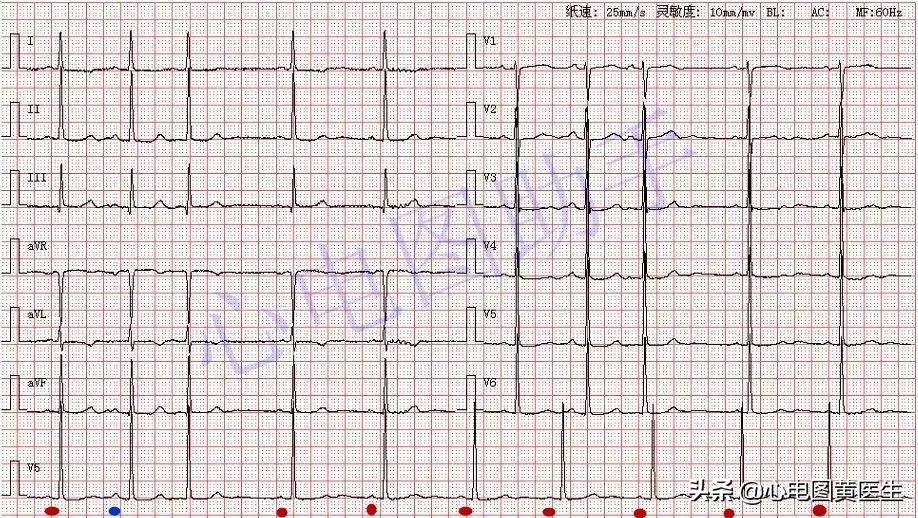 窦房结内游走性心律是什么意思,窦房结内游走性心律不齐