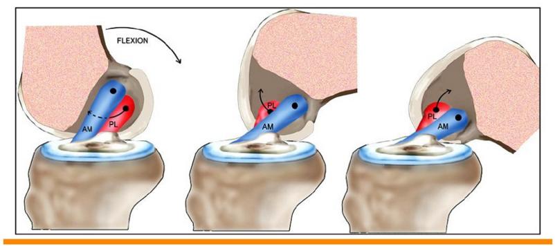 判断前交叉韧带断裂最简单的方法,前十字交叉韧带撕裂自测