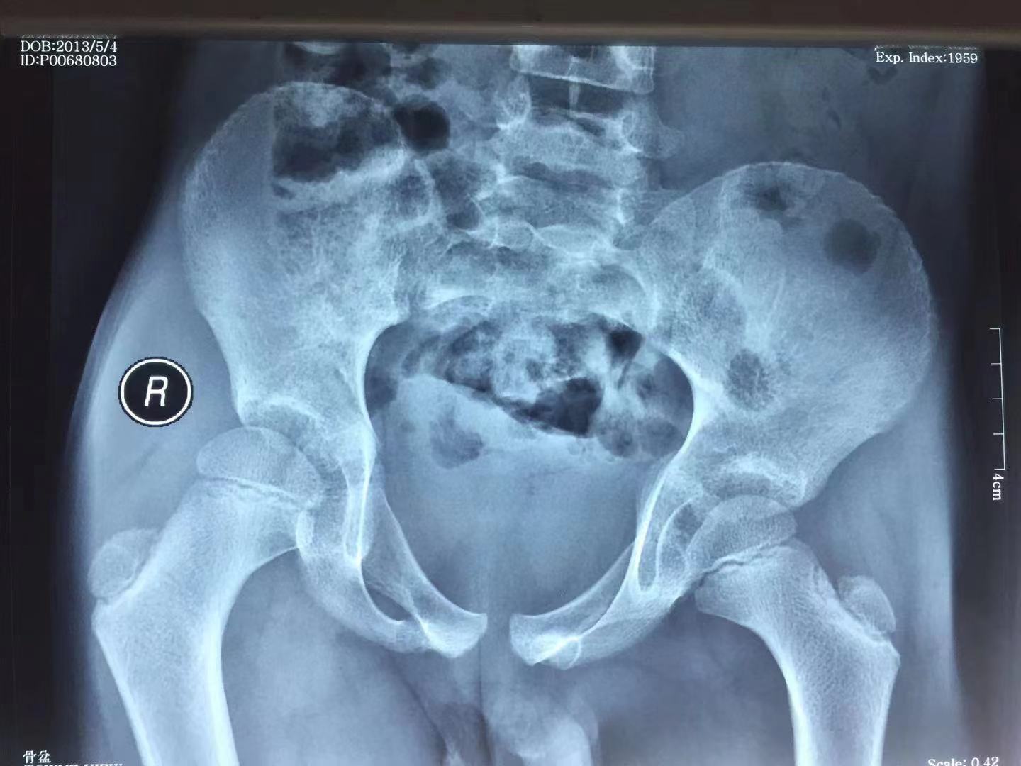 髋关节滑膜炎中药方,髋关节滑膜炎儿童