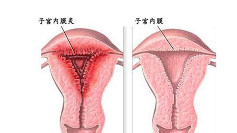 子宫内膜炎影响怀孕吗,慢性子宫内膜炎治好后容易怀孕吗