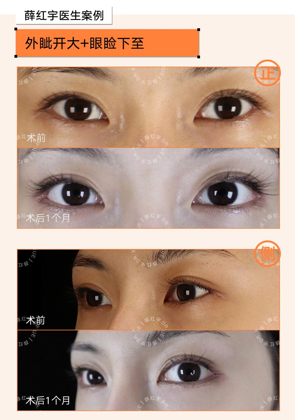 要不要开下眼睑,要不要开内眦赘皮