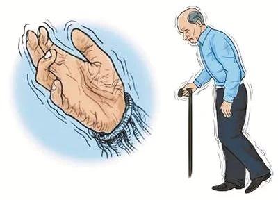 帕金森病不仅仅是手抖这么简单,帕金森病并非手抖那么简单