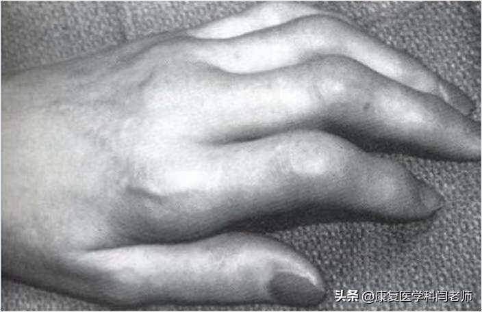 脑卒中后偏瘫患者常见并发症:肩手综合征的康复治疗