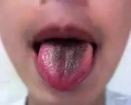 舌头出现信号对身体有什么危险,舌头出现这种症状就要警惕生病了