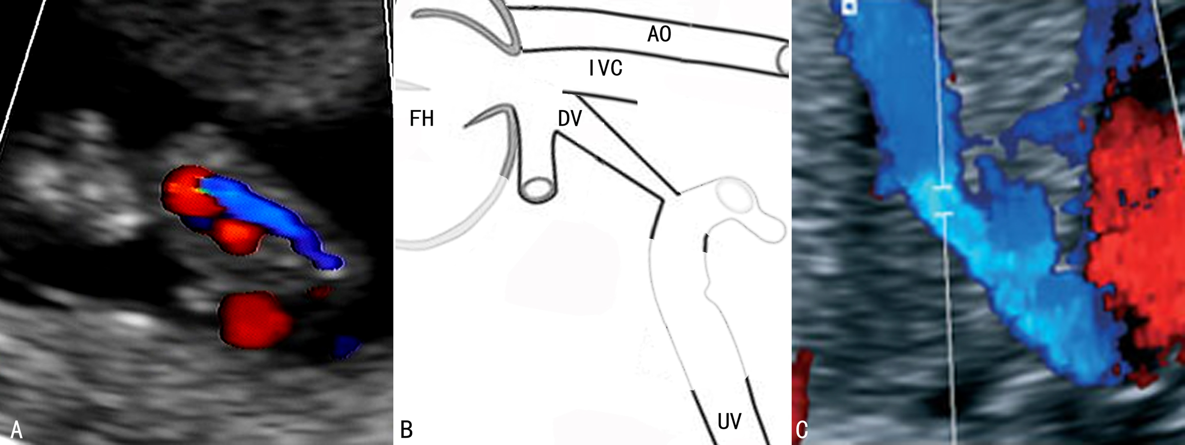 胎儿系统超声检查彩色多普勒,胎儿多普勒超声的一些数据