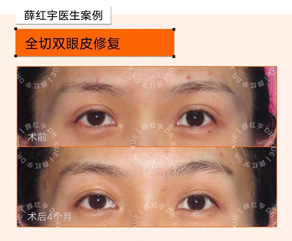 双眼皮整形修复,潘贰双眼皮修复