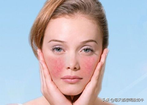 脸部毛孔大泛红有红血丝,脸部毛孔粗大有红血丝怎么改善