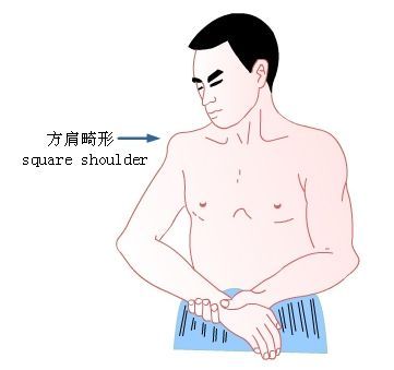 摔倒的肩膀脱位最佳治疗方法,摔了一跤肩袖损伤怎么办