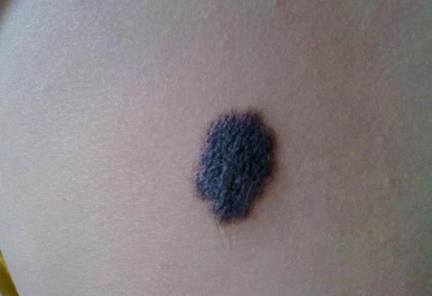 软痣凸起是癌变信号吗,痣变大凸起就一定是要癌变了吗