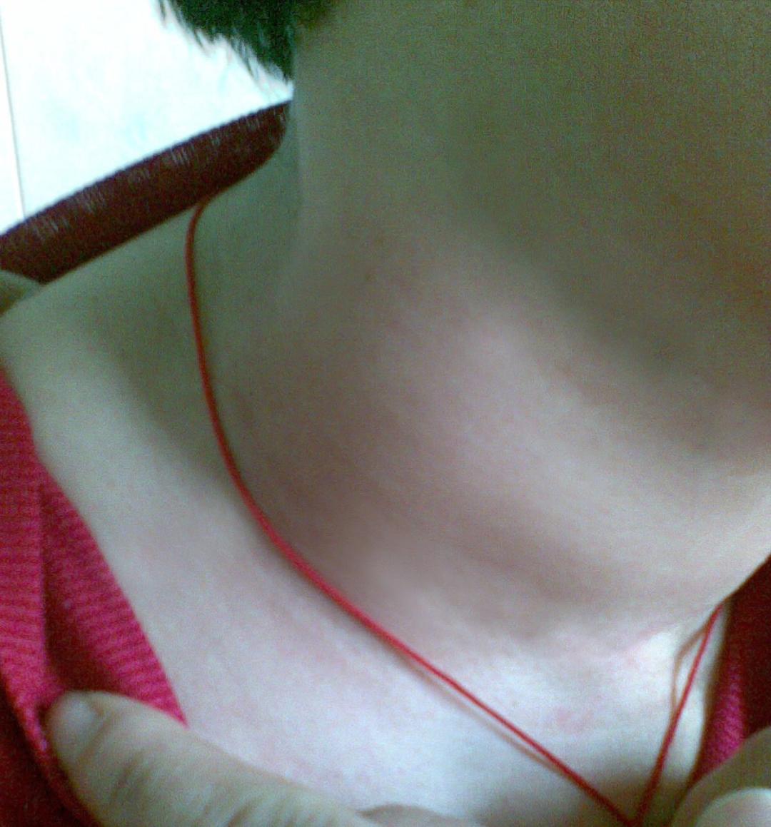 甲状腺结节07x06实性结节严重吗,甲状腺结节1.2厘米囊实性结节