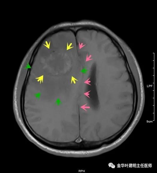伴有脑转移了的肺癌能手术吗？