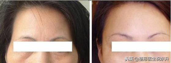 鼻唇沟泪沟法令纹,18岁有眼沟纹和法令纹怎么办