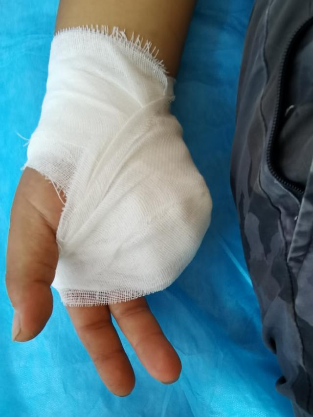 手部拳击骨折，不需要石膏固定，更不需要手术！！