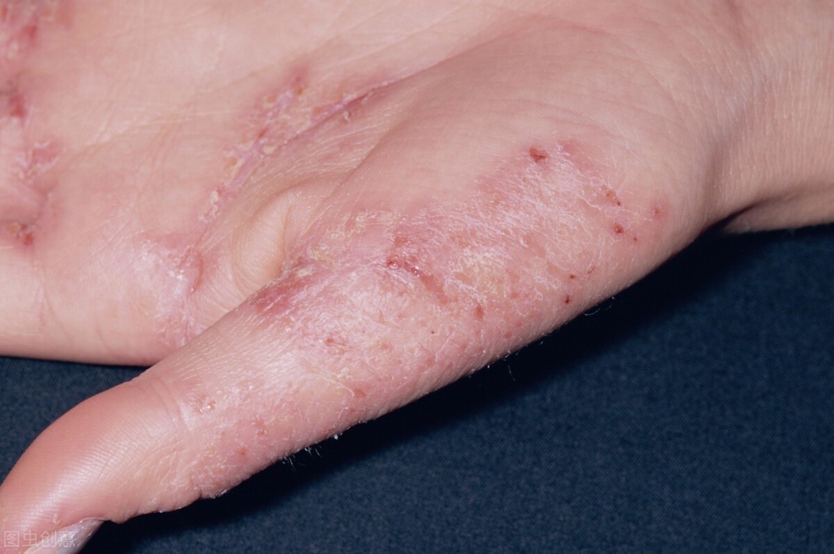 夏季湿疹反复的原因有两个,夏天湿疹与夏季皮炎的区别