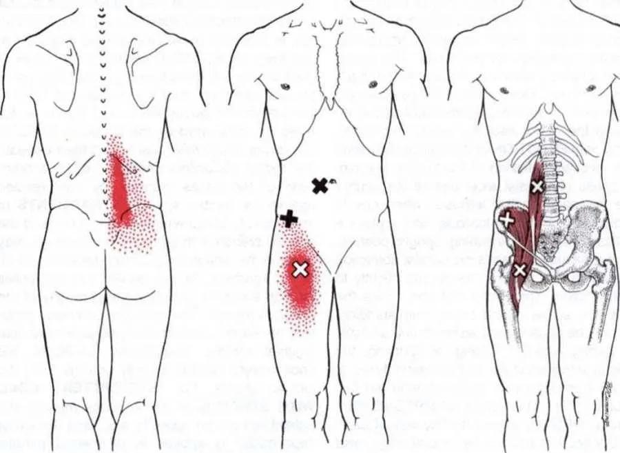 练腹部髂腰肌疼痛怎么恢复,髂腰肌训练时腹股沟疼痛是为什么