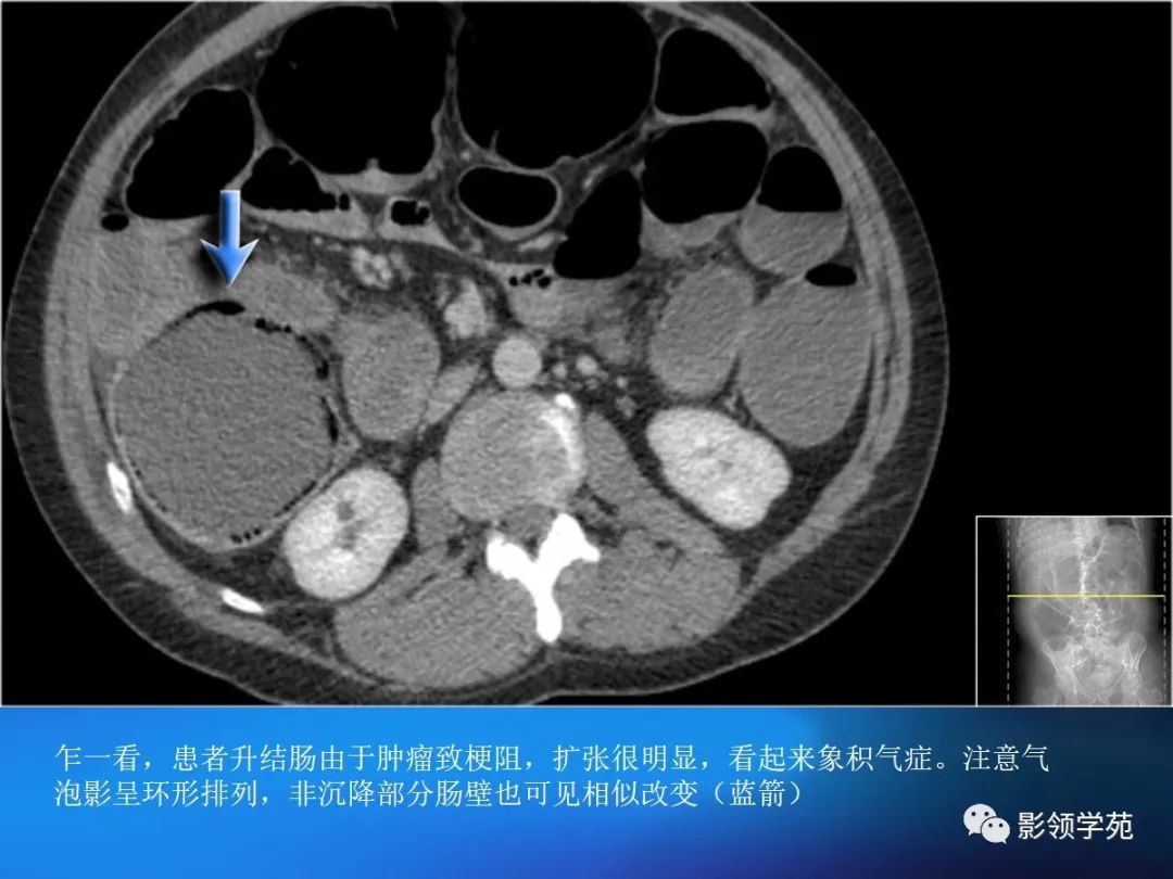 肠道内壁增厚,肠道扩张ct表现