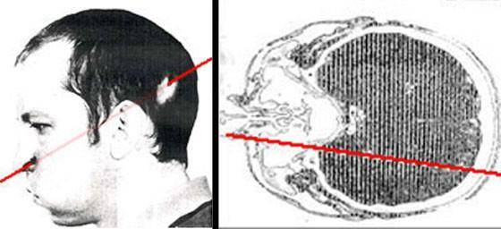 他被高能质子束直接爆头,几十年过去,被辐射的左脸依旧年轻