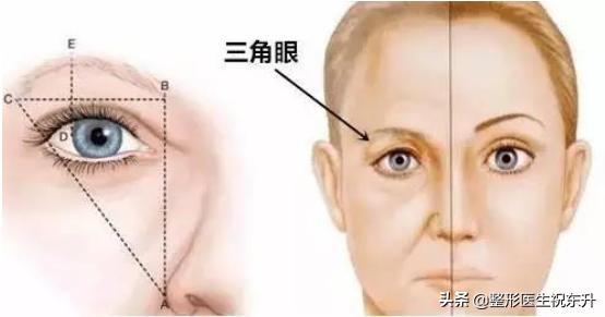三角眼提眉有后遗症吗,三角眼提眉松弛怎么治