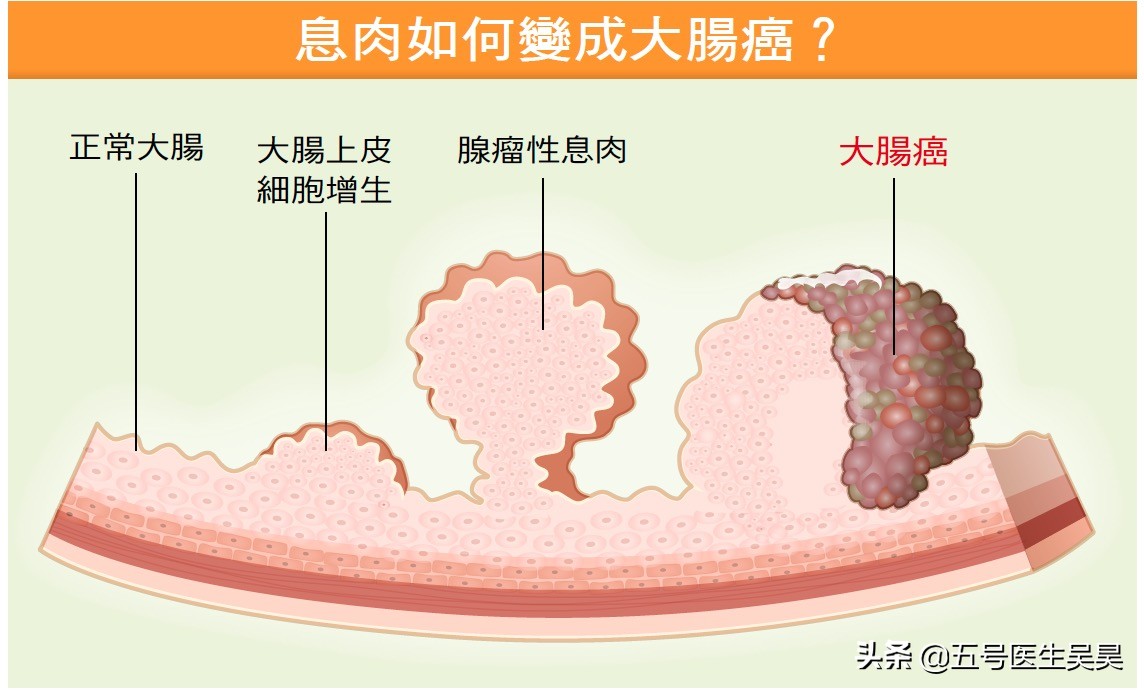 关于“大肠息肉”的6个问题，搞清楚再去检查也不迟