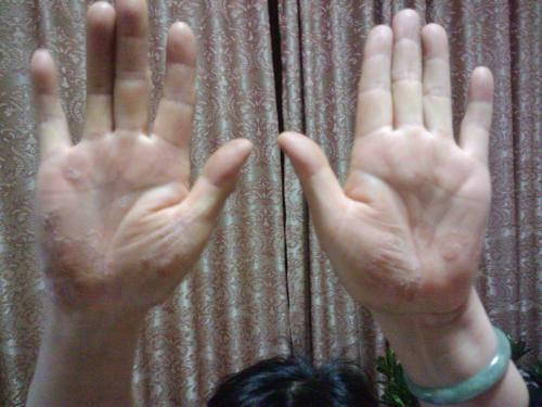 儿童牛皮癣怎么治疗才能彻底根除,目前全国治疗牛皮癣用的生物制剂