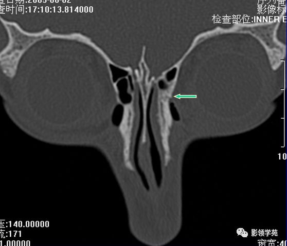 鼻骨骨折的检查方法,鼻骨骨折影像学表现