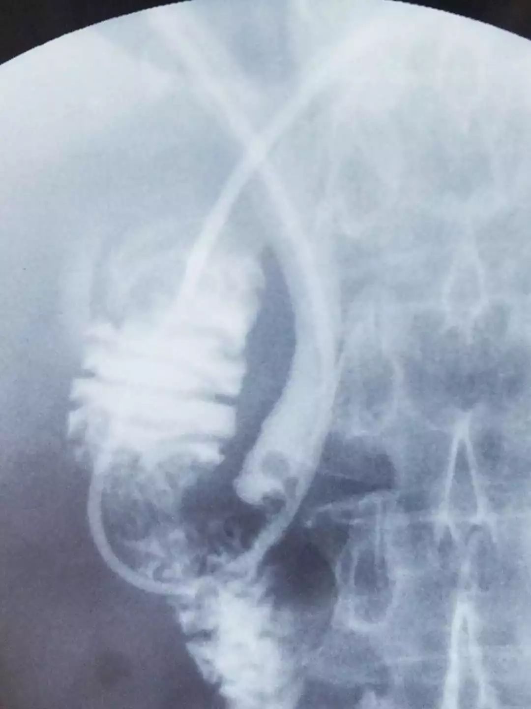 红兴隆医院住院部,红兴隆中心医院神经内二科