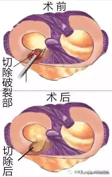 内侧半月板后角损伤怎么治疗,半月板损伤有积液的最好治疗