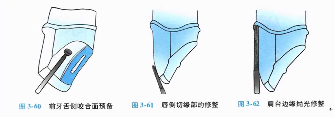 口腔金属冠与全瓷冠的区别,牙科医生讲义