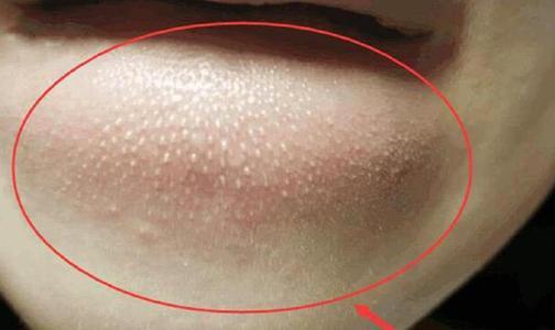 下巴有一块凸起摸着有一个小疙瘩,脸颊靠下巴有个凸起的硬疙瘩