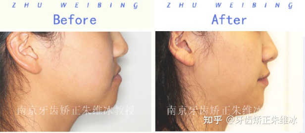 南京透明式牙齿矫正器地包天,18岁功能性地包天能改善面型吗