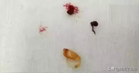 宝宝有耳屎家长一定不能这样做,男孩不掏耳屎进医院