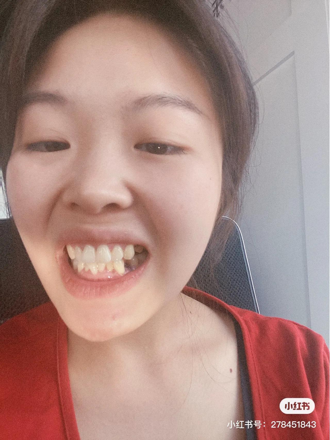 拔牙附近的牙隐隐痛酸是怎么回事,突然牙很酸痛是怎么回事