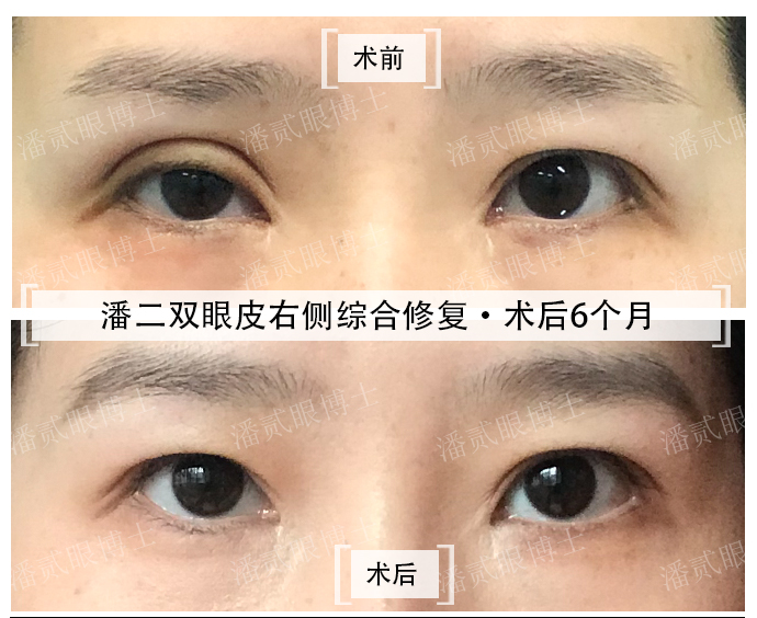 双眼皮修复具体要问什么,双眼皮修复过程中注意事项