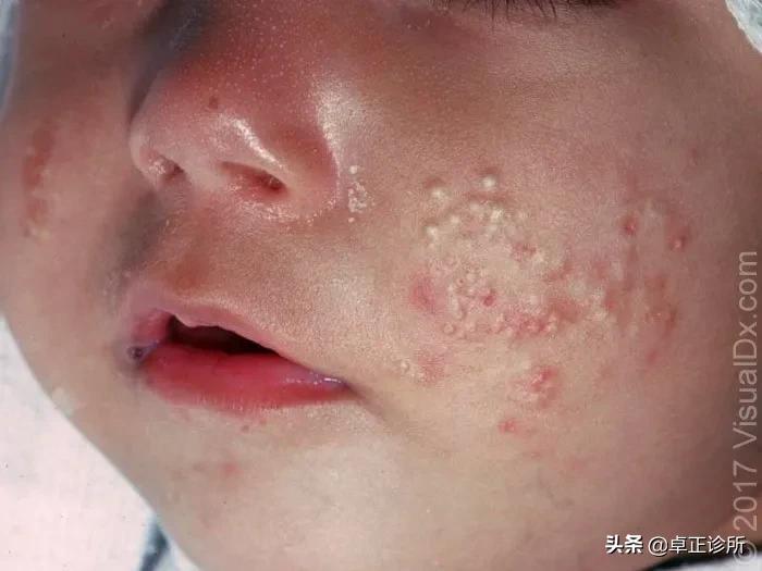 婴儿长疮怎么引起的,小孩长疮留下的印记怎么消除