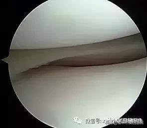 内侧半月板后角损伤怎么治疗,半月板损伤有积液的最好治疗