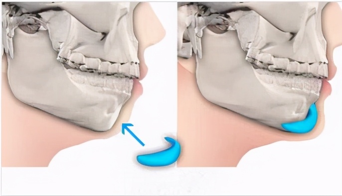 什么样的下巴才是最好看的,什么样的下巴是丰满的