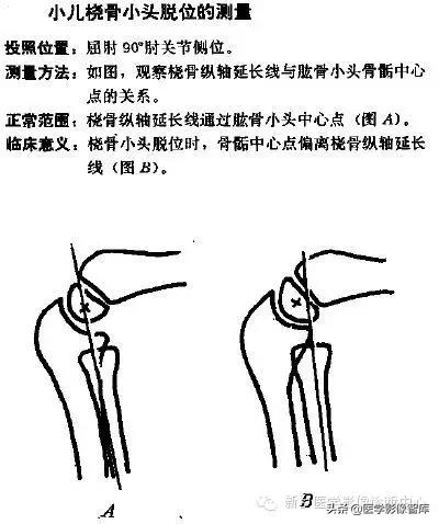 肘关节x线测量,肘关节骨骺示意图