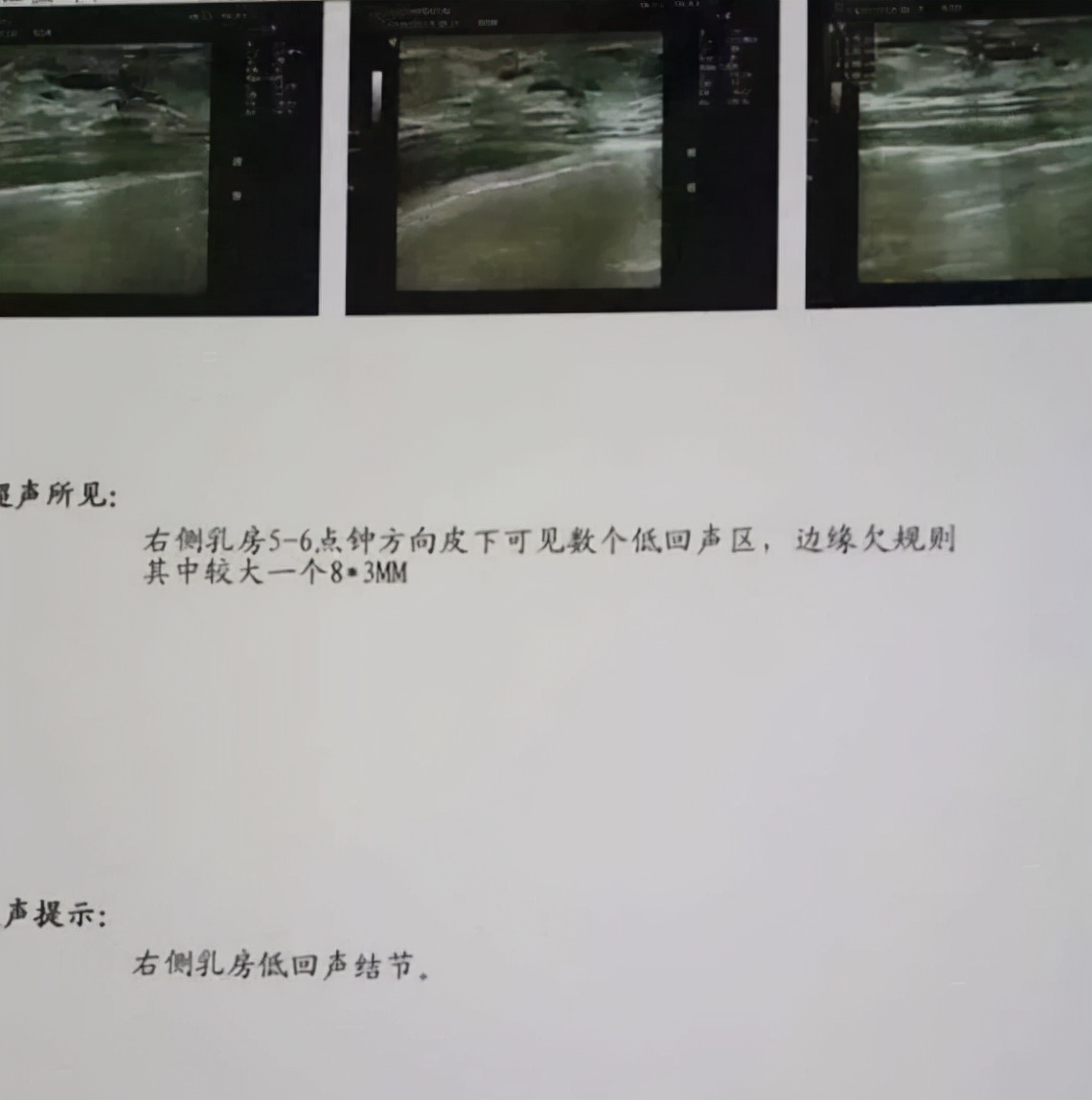 乳房结节切除,看似一劳永逸的手术,实则是将患者“画地为牢”