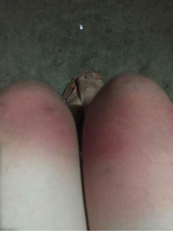 长期钓鱼晒伤怎么修复,夏天钓鱼怎么防止被晒黑