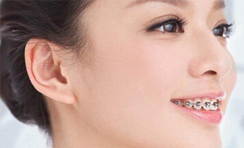 40岁戴牙套可以矫正牙齿吗,哪种牙套矫正牙齿效果最好
