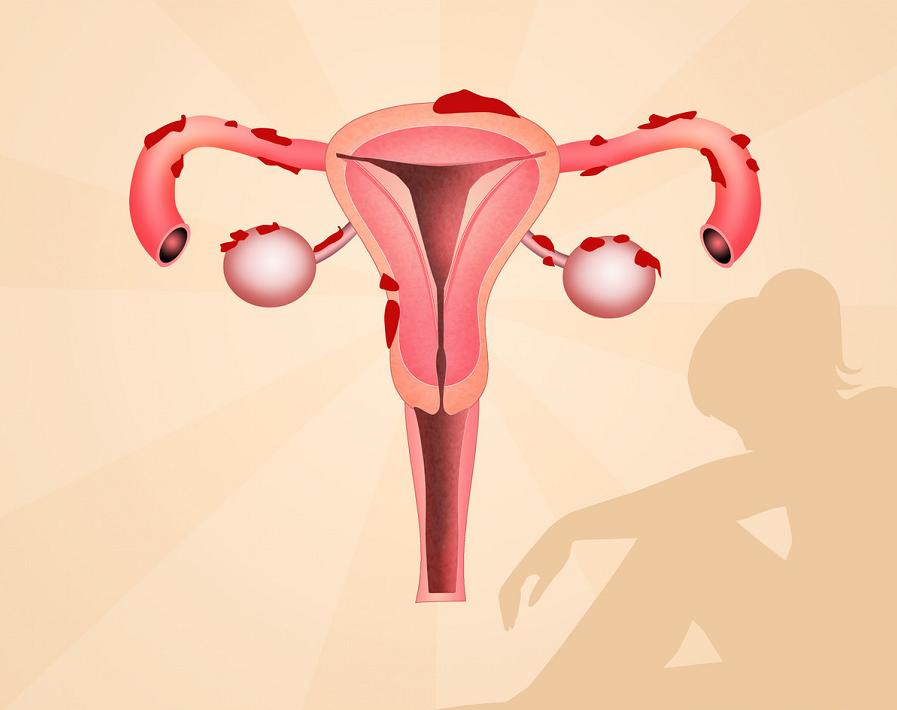 子宫肌瘤恶化需要怎么做,子宫肌瘤要注意什么生活习惯