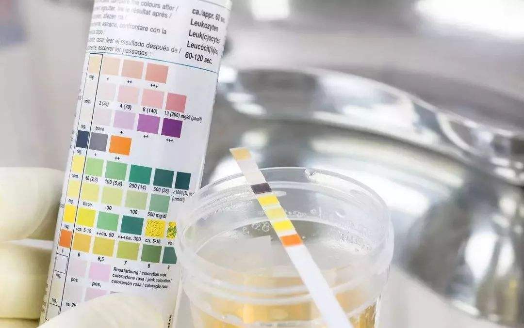 尿糖和糖尿病的区别,尿糖数值多少是糖尿病