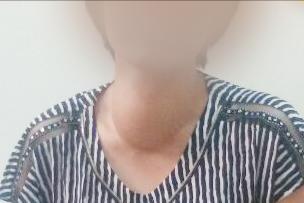 甲亢相关案例视频,亚临床甲亢怎样快速自愈