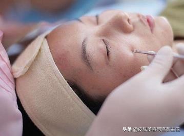 去黑头的方法快速有效,去除黑头以后皮肤该如何护理