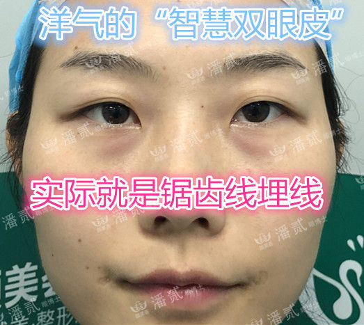 不割不埋线的双眼皮纳米技术,纳米无痕双眼皮和非手术区别