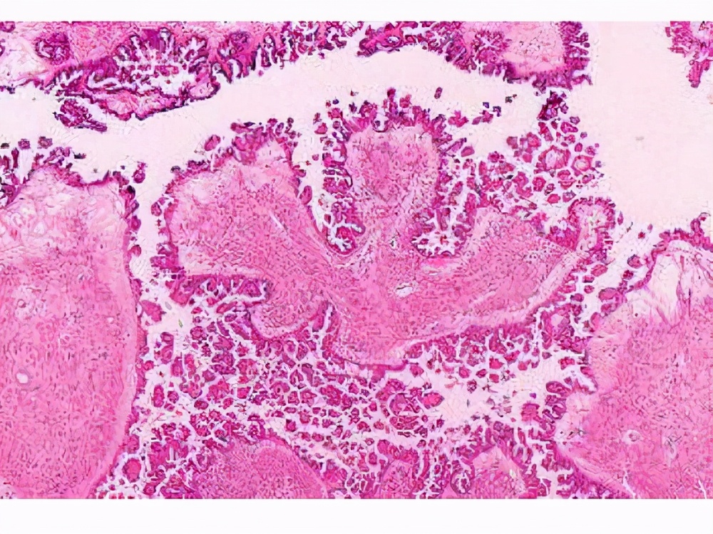 交界性的恶性肿瘤能治愈吗,交界性肿瘤拒赔如何处理
