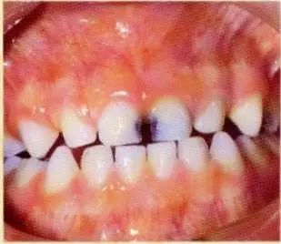 修复一颗蛀牙的全过程,蛀牙早期黑点全治好了的感觉真好