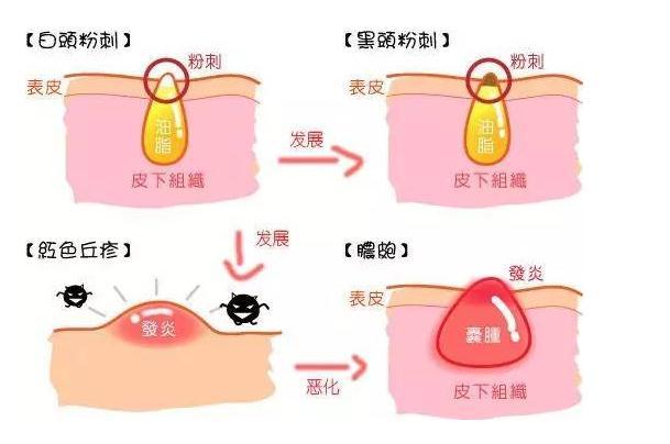 痘痘和闭口有什么区别,痘痘闭口怎么治才能彻底根除