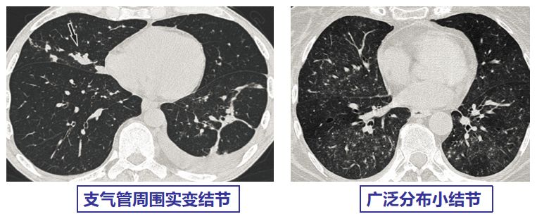专家讲新冠二次感染的情况讲解,感染新冠专家怎么说